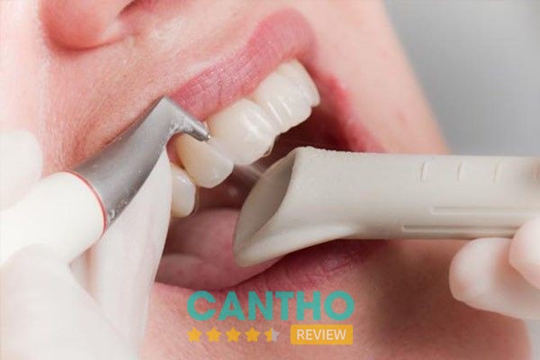 Minh họa dịch vụ cạo vôi răng – Nha Khoa Nhựt Tân