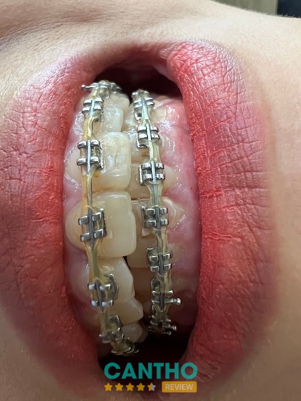 Nha Khoa Tôn Quyền – lấy cao răng