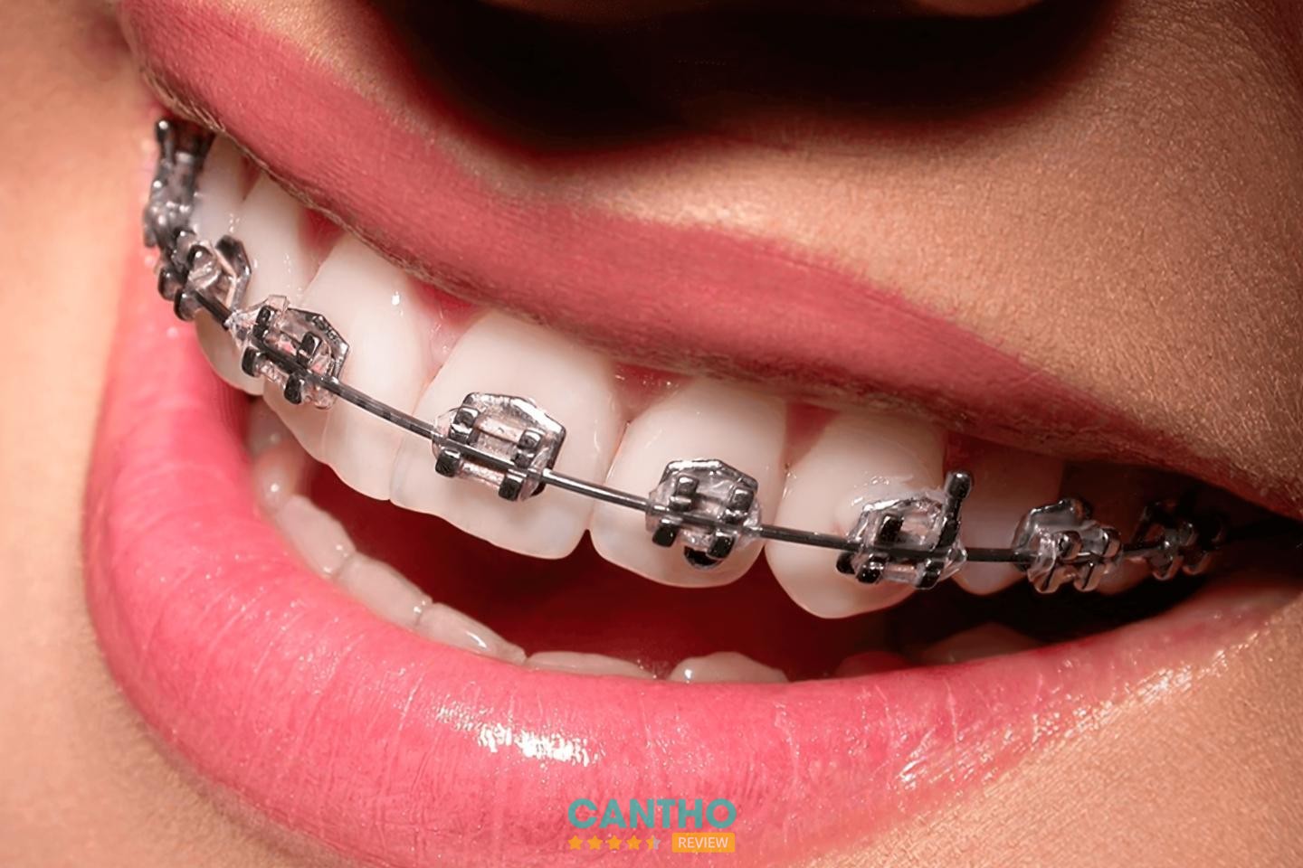 Nha Khoa Sài Gòn Cái Răng niềng răng