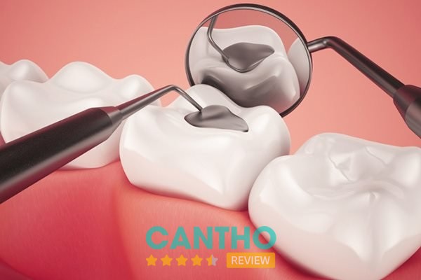 Hình minh họa trám răng tại Phòng Khám Nha Khoa Việt Thái