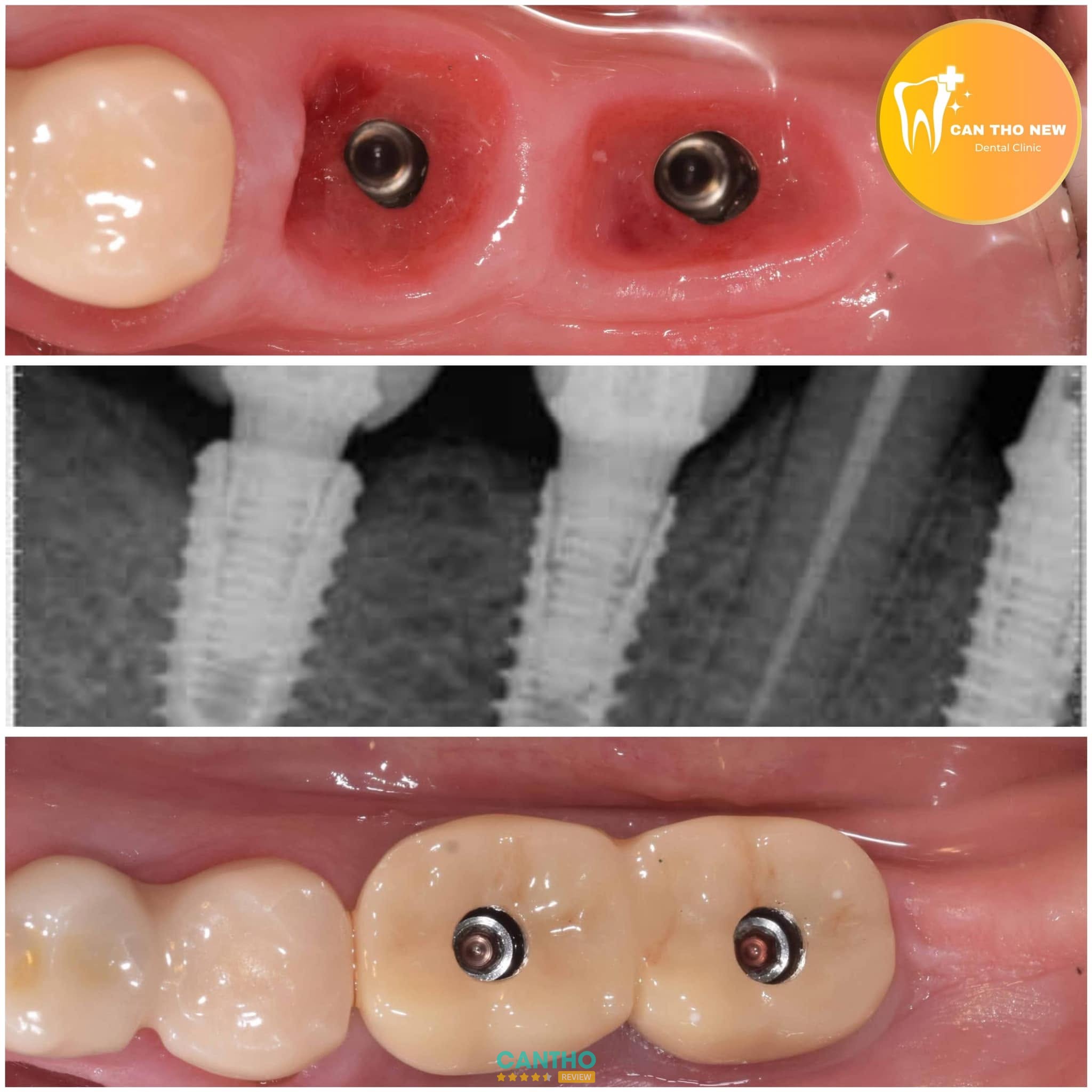 Nha Khoa Cần Thơ NEW - địa chỉ trồng răng Implant ở Cái Răng