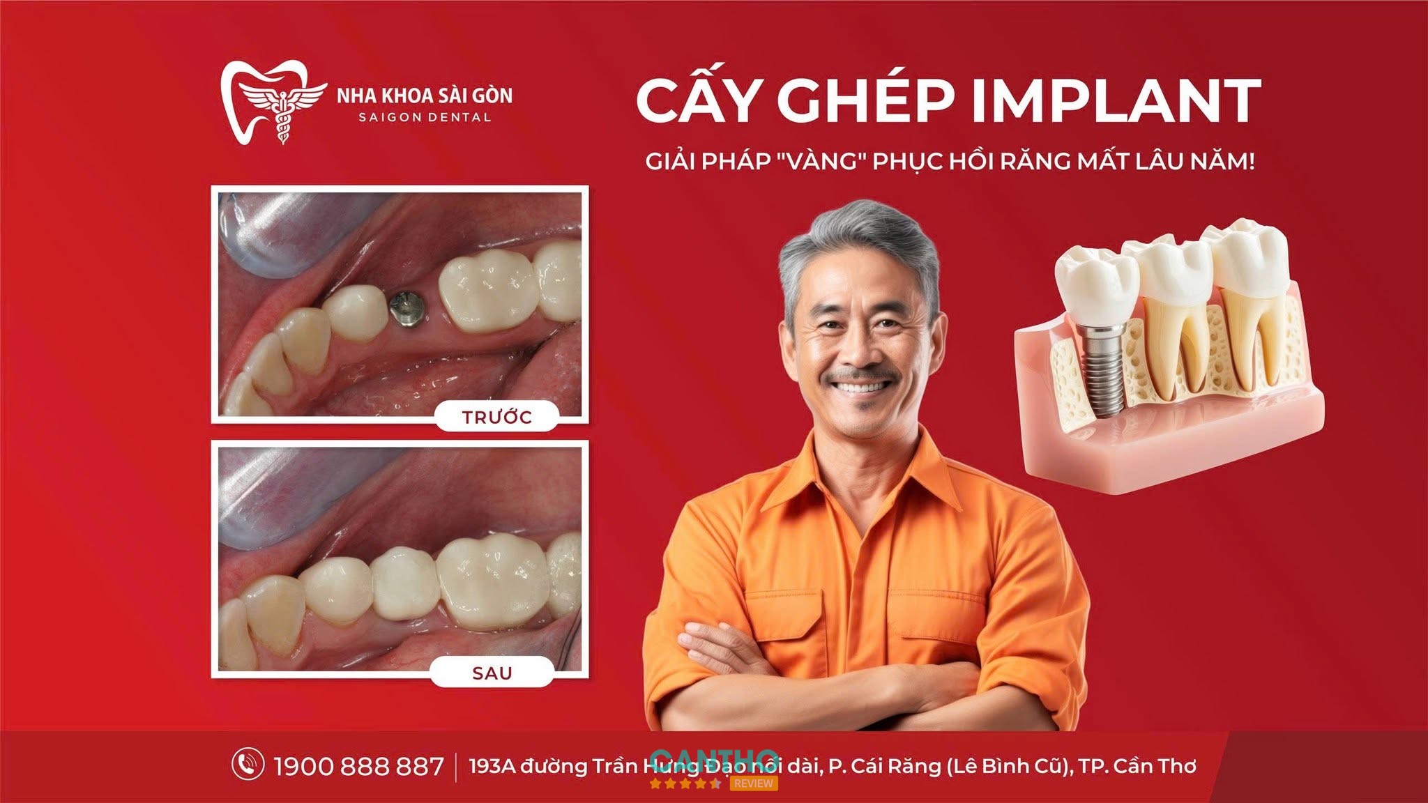 Nha Khoa Sài Gòn Cái Răng - trồng răng Implant