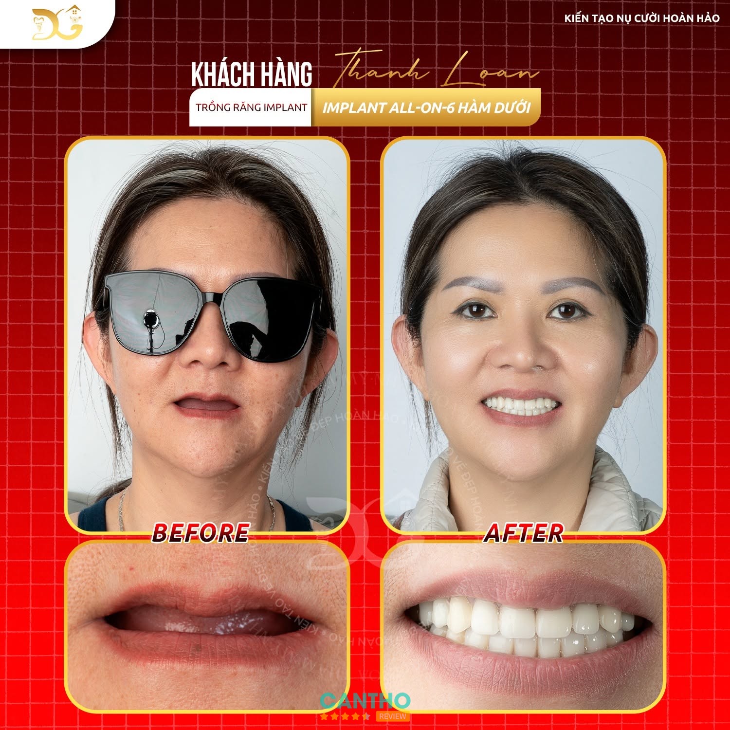 Nha Khoa Ngọc Ngân Luxury - địa chỉ trồng răng Implant ở Cái Răng